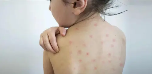 Morbillo: ecco come prevenirlo in maniera semplice ed efficace