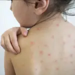 Morbillo: ecco come prevenirlo in maniera semplice ed efficace
