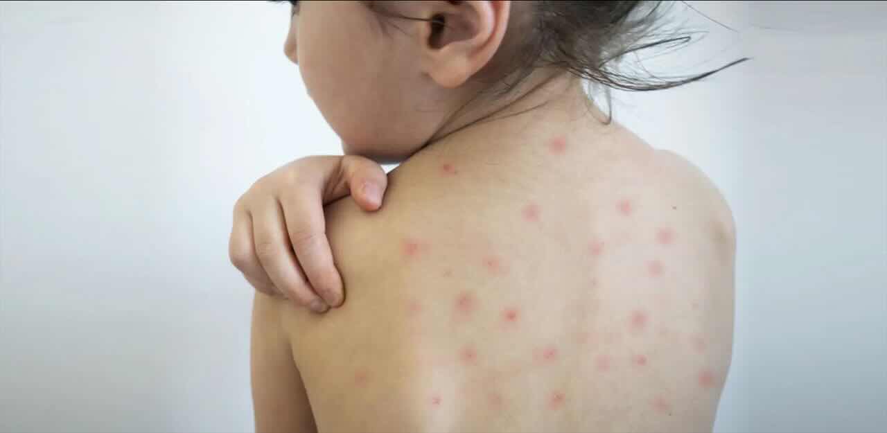 Morbillo: ecco come prevenirlo in maniera semplice ed efficace